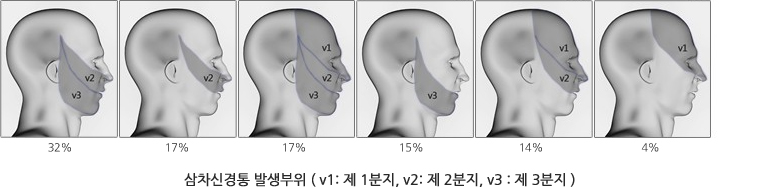 삼차신경통 발생부위 ( v1: 제 1분지, v2: 제 2분지, v3 : 제 3분지 )