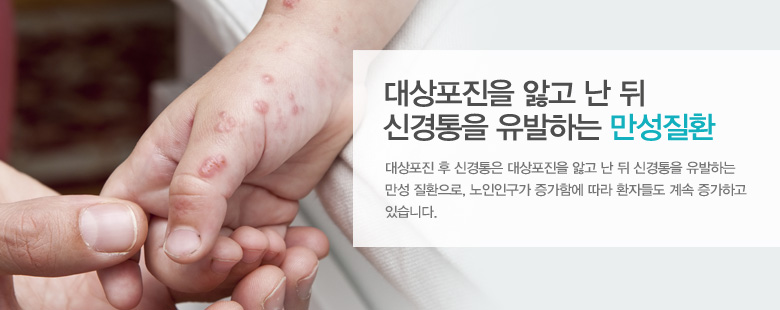 대상포진을 앓고 난 뒤신경통을 유발하는 만성질환